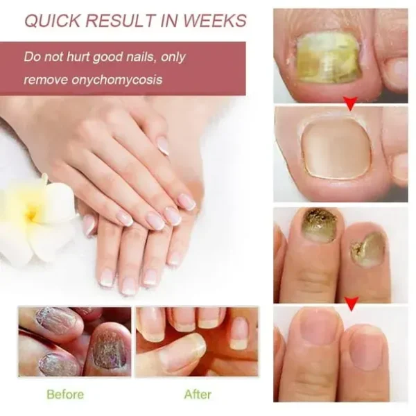 Fast Nail Fungal Treatments Nail Repair Essences Serum Care Treatments Foot Nail Fungus Removal Gel Paronychia Onychomycosis - Image 2