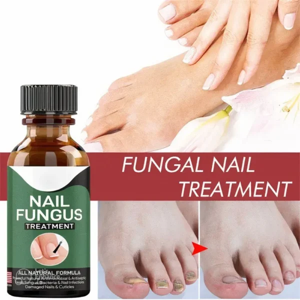 Fast Nail Fungal Treatments Nail Repair Essences Serum Care Treatments Foot Nail Fungus Removal Gel Paronychia Onychomycosis